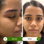 Facial Before After