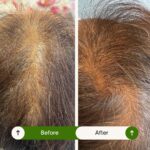 hair PRP before after