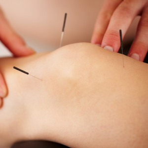 Acupuncture