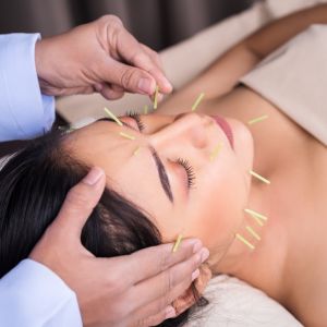 Acupuncture Balancing the Body and Mind