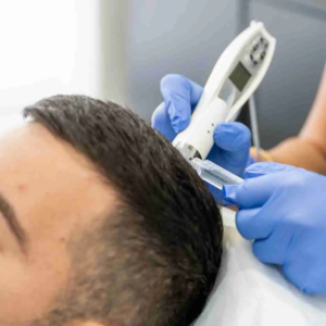 Exosome Therapy The Future of Hair Restoration