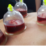 Hijama Therapy Detoxify & Improve Circulation Naturally