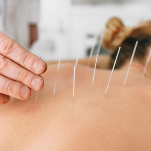 What is Acupuncture